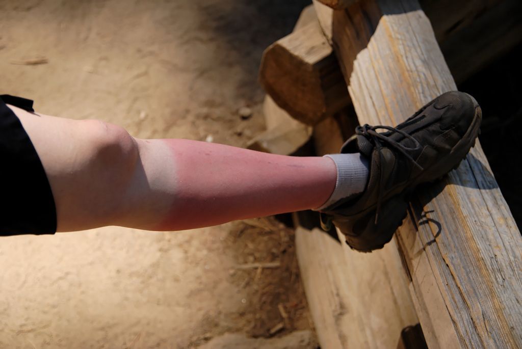 2025 میں جلنے کے 10 بہترین علاج