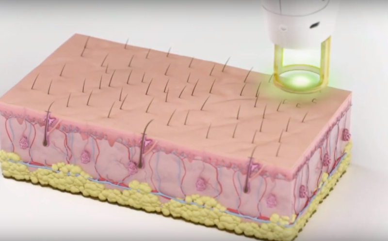 Klinik dan salon terbaik untuk laser hair removal di Voronezh 2025