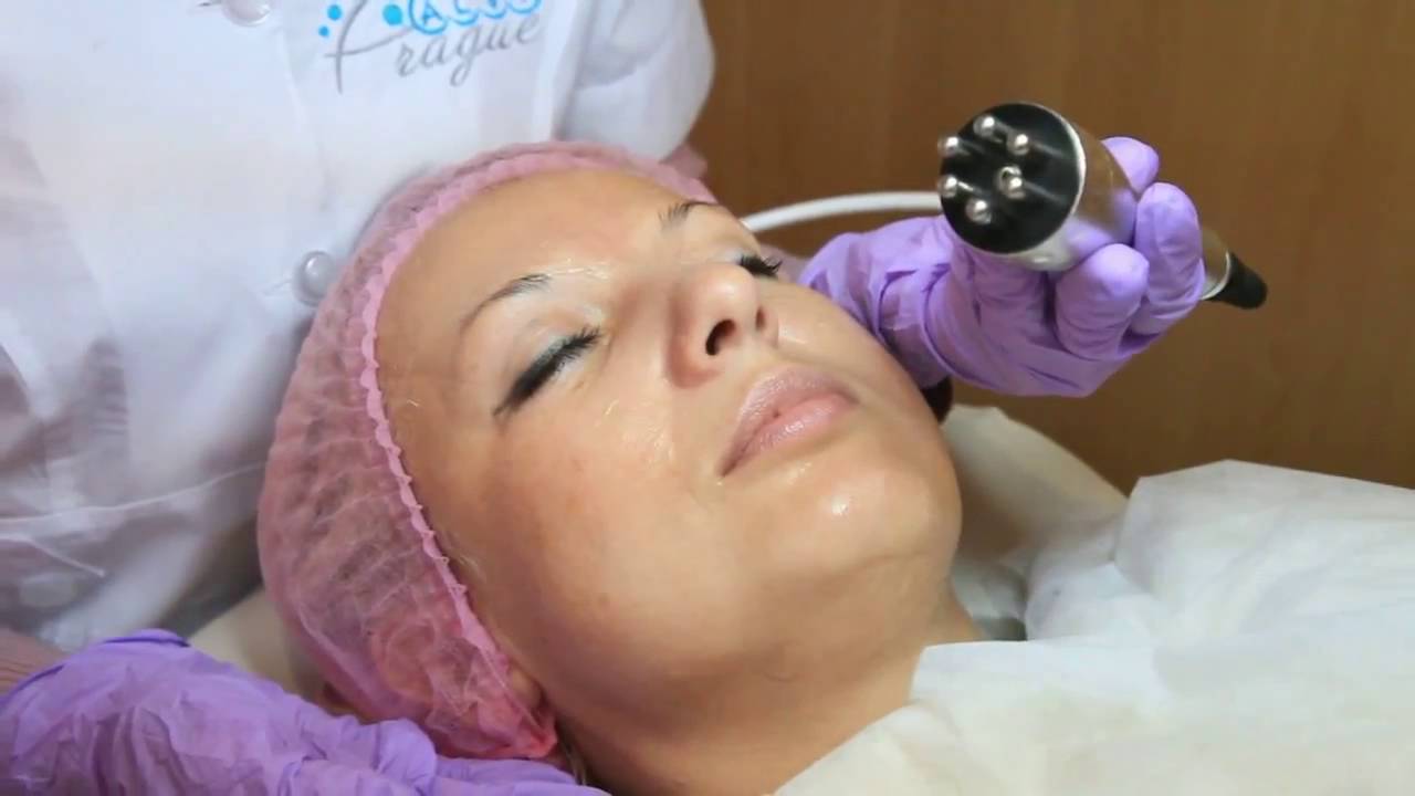 Peringkat perangkat terbaik untuk pengangkatan RF pada tahun 2025