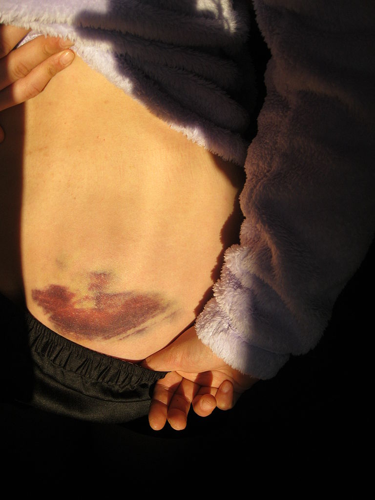 Peringkat solusi terbaik untuk memar untuk 2025