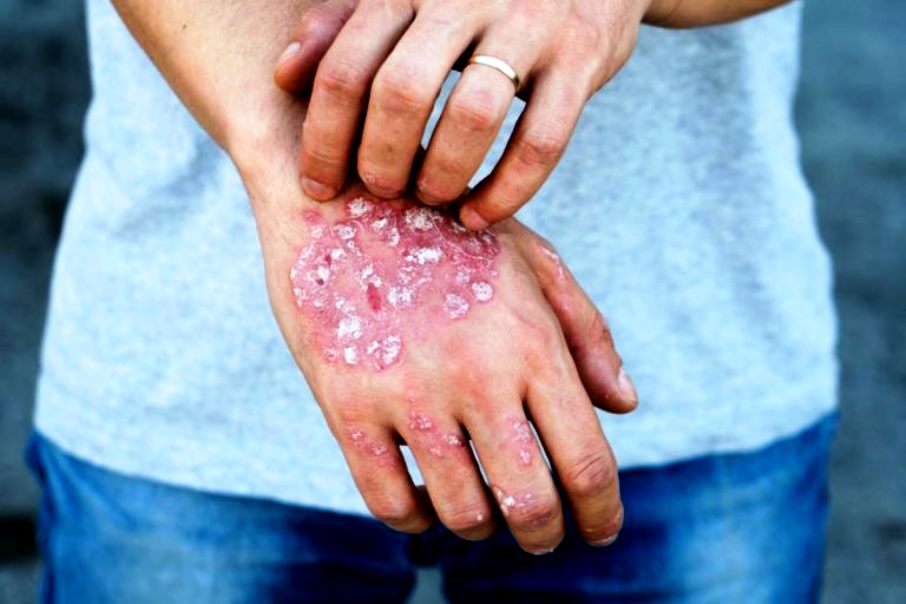 Peringkat obat terbaik untuk psoriasis untuk 2025