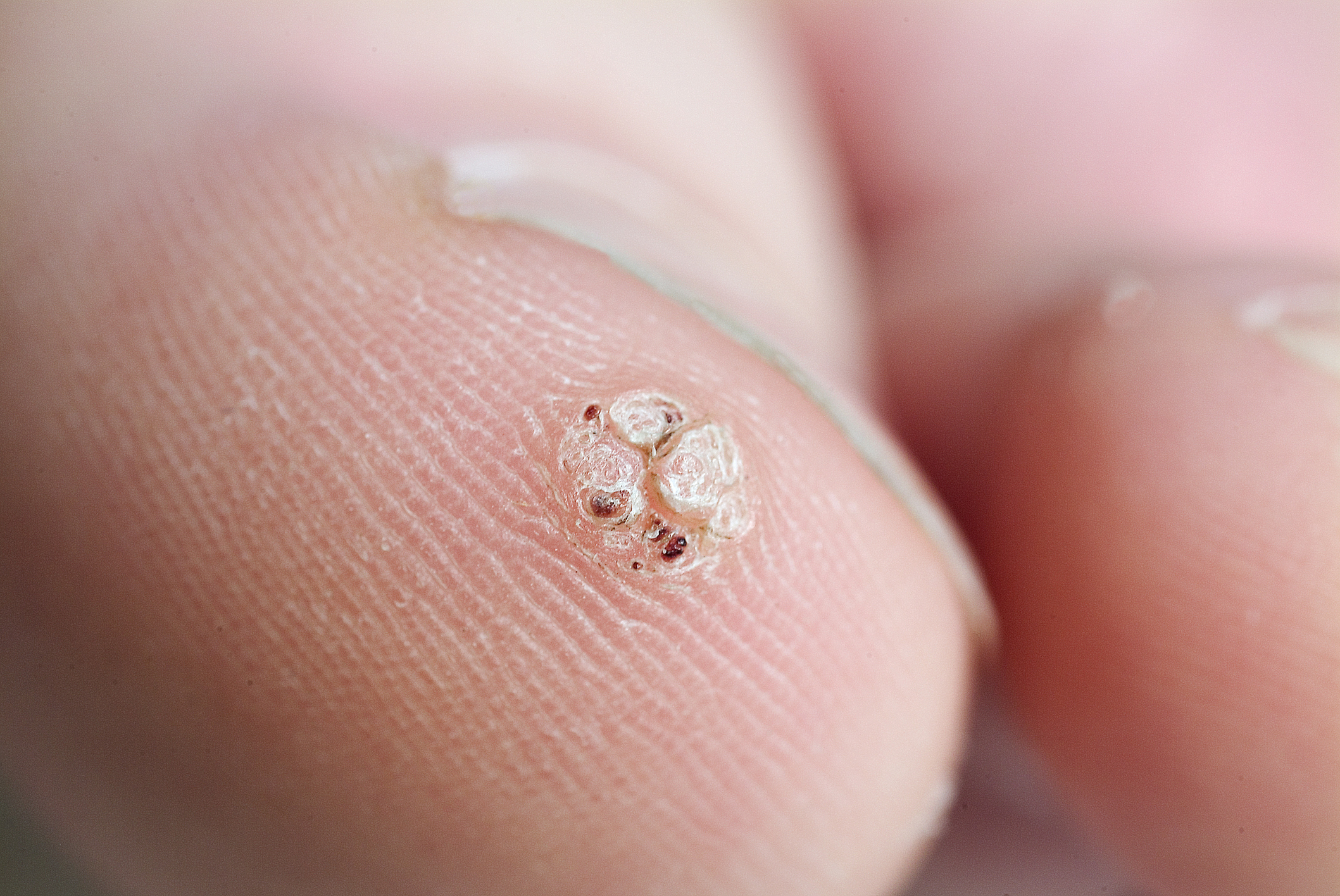 2025 کے لیے مسے کے بہترین علاج کی درجہ بندی