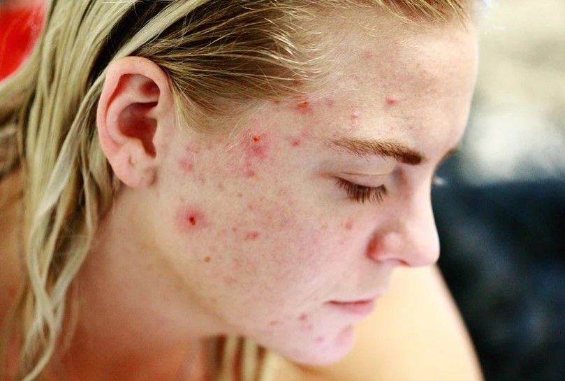 2025 کے لیے مہاسوں کی بہترین گولیوں کی درجہ بندی